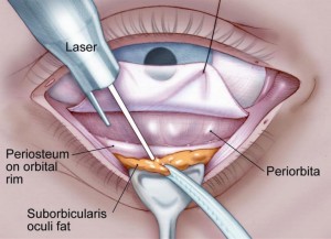 Blefaroplastica