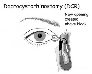 Dacriocistorinostomia