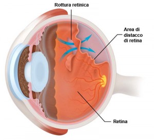 Distaccodiretina