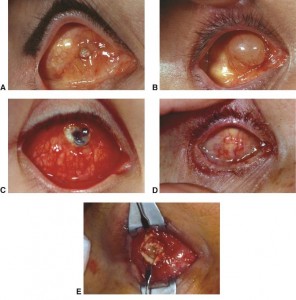 Enucleazione complicanze