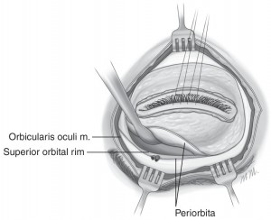 Exenteratio orbitae04