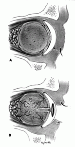 Fibrovascolarizzazione