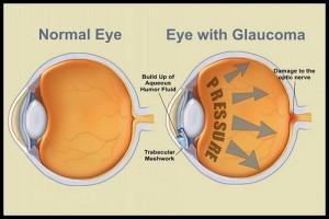 Glaucoma