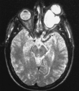 Glioma