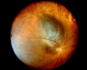 Melanoma_oculare-fondo_retinico-web