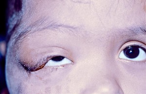 Neurofibroma plessiforme