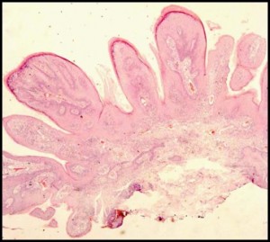 Papilloma2