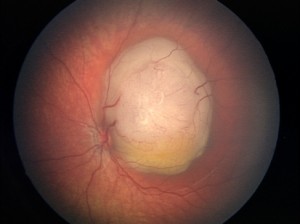 Retinoblastoma2