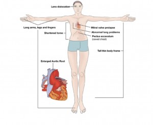 Sindrome marfan