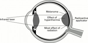 Termoterapia transpupillare