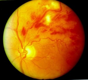 Trombosi retinica