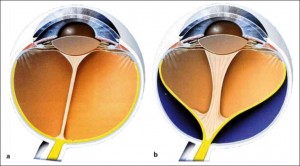 Bulbo normale (a) e con Vitreo primitivo iperplastico (b)