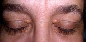 Xanthelasma