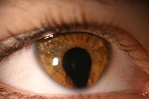 coloboma