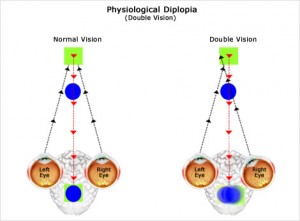 diplopia-esquema