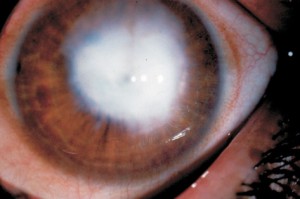 leucoma-corneal