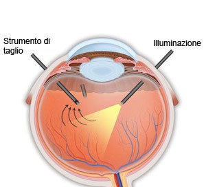 vitrectomia02