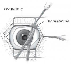 Peritomia capsula di Tenone