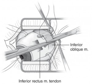 Resezione muscoli extraoculari