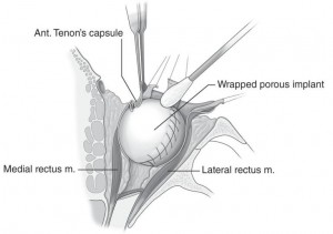 Enucleazione06